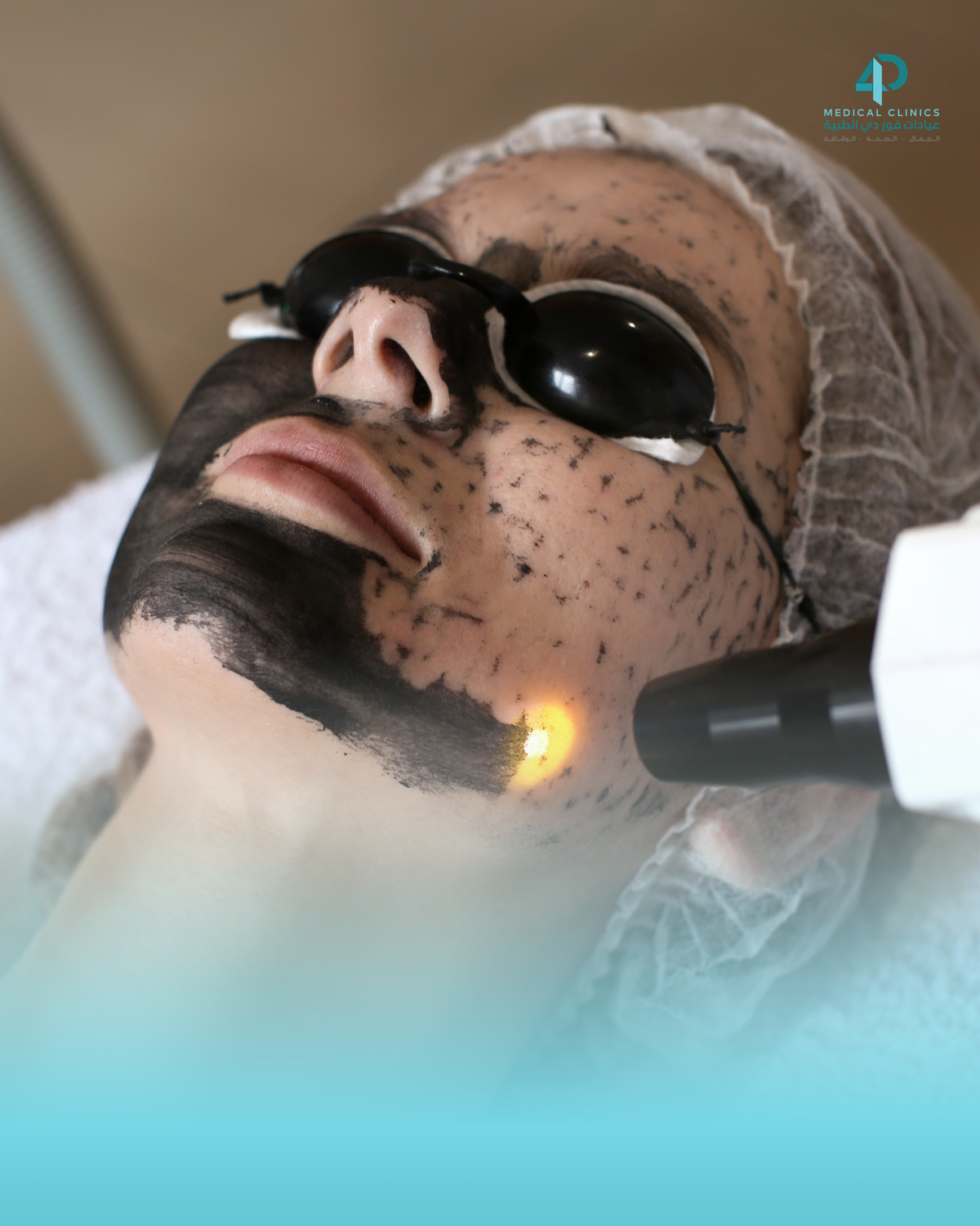 Fractional laser
